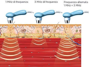 L'ultrasuonoterapia è una forma di trattamento comune in ambito sanitario che utilizza le onde sonore con frequenza superiore alla nostra soglia di udito. È considerata una terapia termica meccanica che, attraverso la penetrazione delle onde sonore, è capace di ottenere particolari benefici.